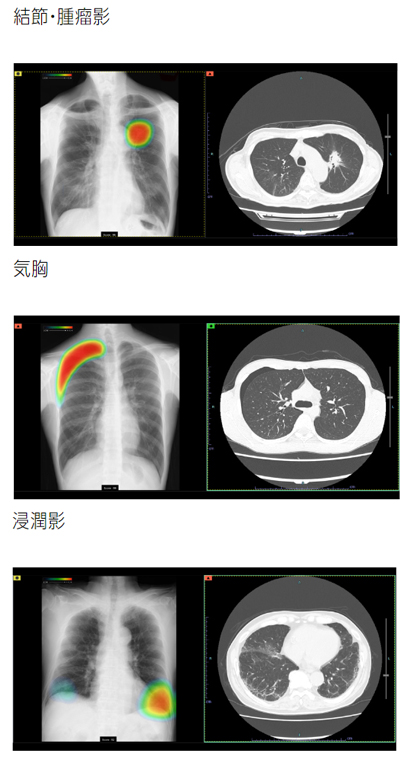 CXR-AIDシステムのイメージ画像